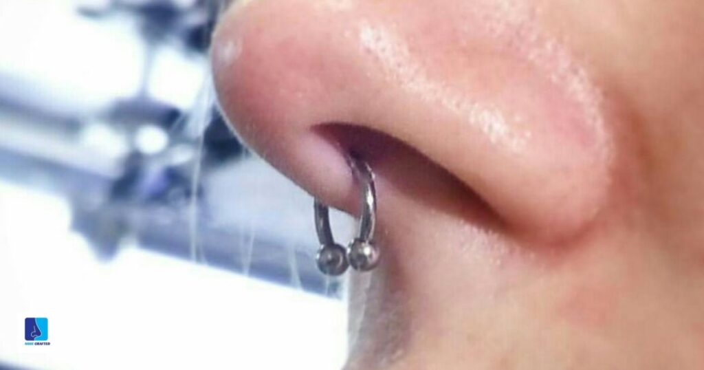 Embedded Nose Piercing Removal