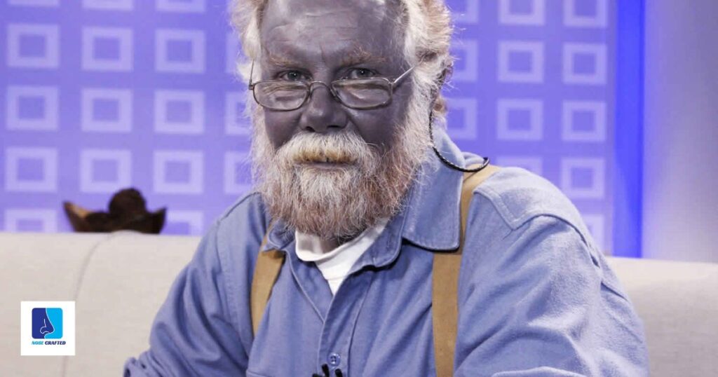 Identifying Symptoms of Argyria